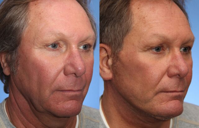 Plastic Surgeries for Men