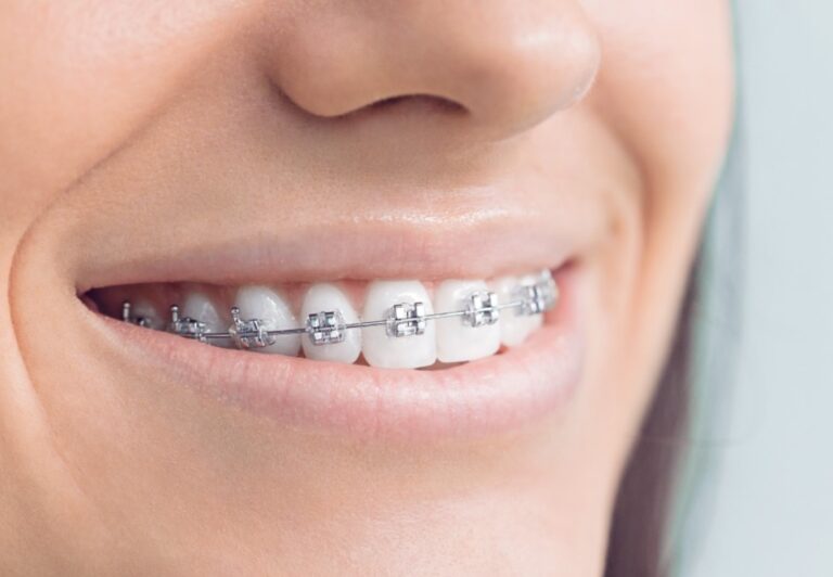 What’s the Difference Between Braces and Veneers? EDM Chicago
