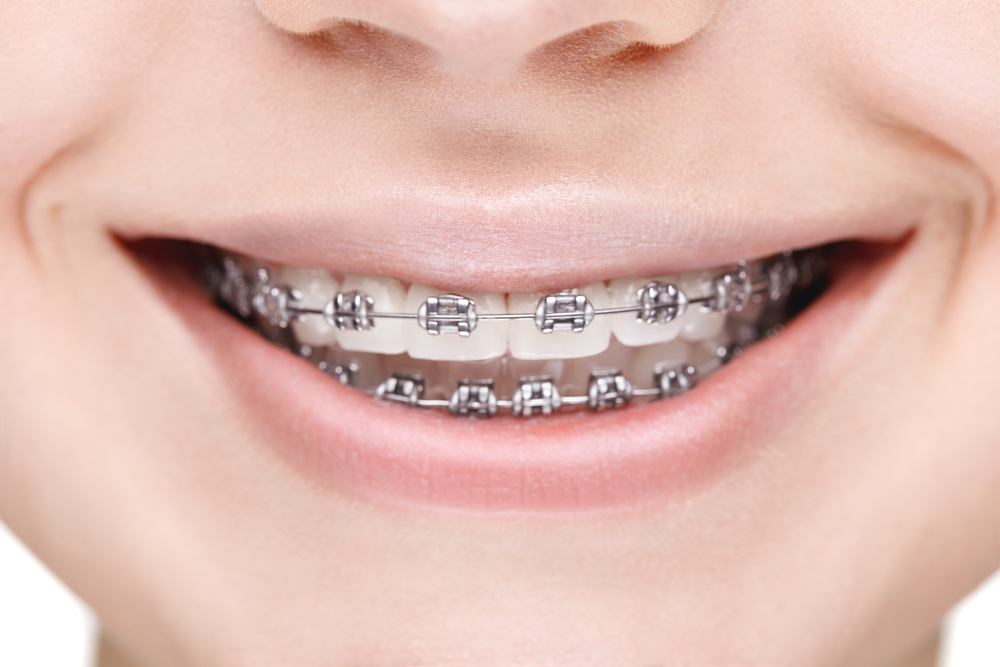 What’s Wrong With Metal Braces