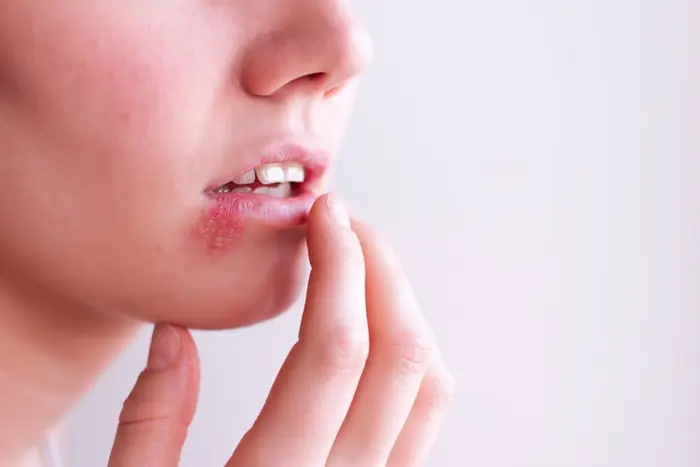 Living With Herpes