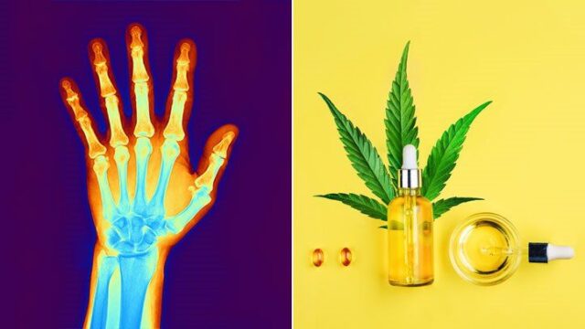 Joint Health Revolution - CBD's Impact on Arthritis Management