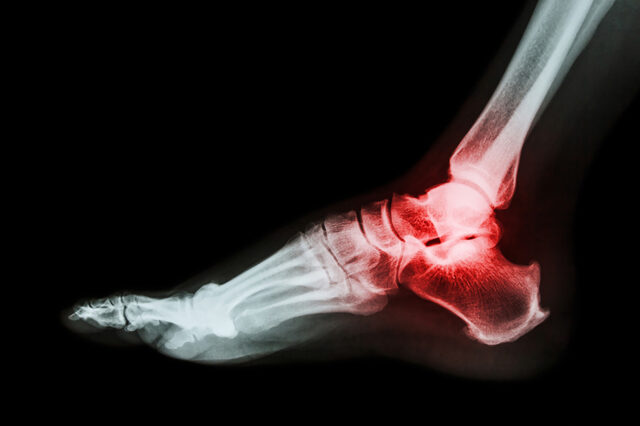 The Role of Inflammation in Arthritis